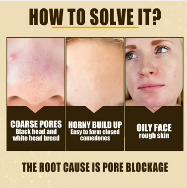 Pore Shrinking Face Serum – Blackhead Removal & Oil Control