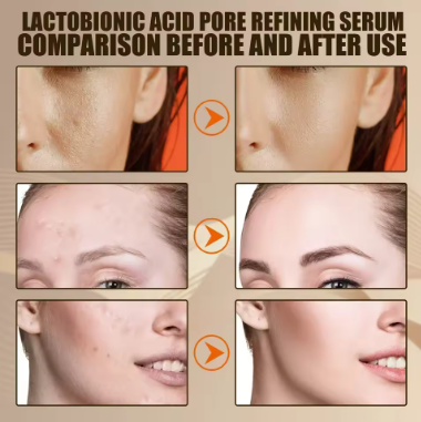 Pore Shrinking Face Serum – Blackhead Removal & Oil Control